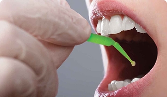 Silver diamine fluoride applied to a tooth