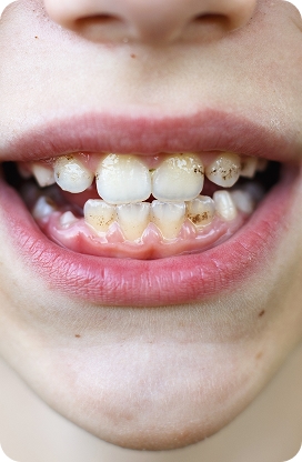 A child smiling during a pediatric dental appointment